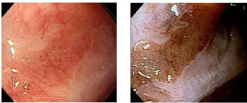 常见的内镜染色方法原理、内镜下表现