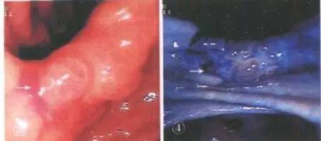 常见的内镜染色方法原理、内镜下表现