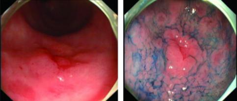 常见的内镜染色方法原理、内镜下表现