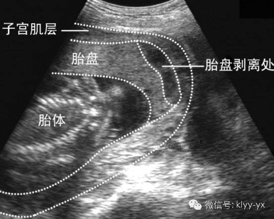 世界防治哮喘日内容,世界防治哮喘日动画