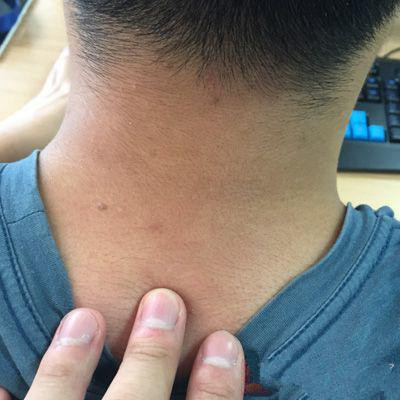 身体一处发黑暗示了2种癌症,身体有部位发黄怎回事