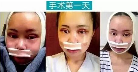 重庆女孩自曝整容日记，迷教主花百万变形为Angelababy