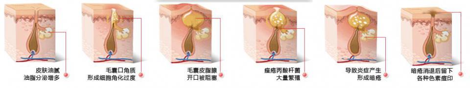为什么很多人治疗痘痘不能根治,痘印太多怎么祛痘痘最有效