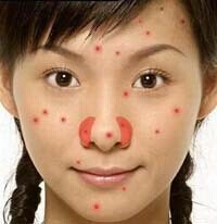痘痘是身体什么地方出了问题,痘痘告诉你哪里生病了