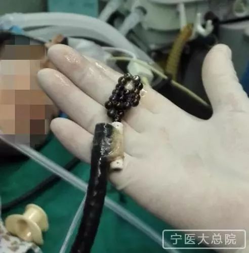 小孩误吞三颗磁力珠,3岁男童误吞10多颗磁力珠