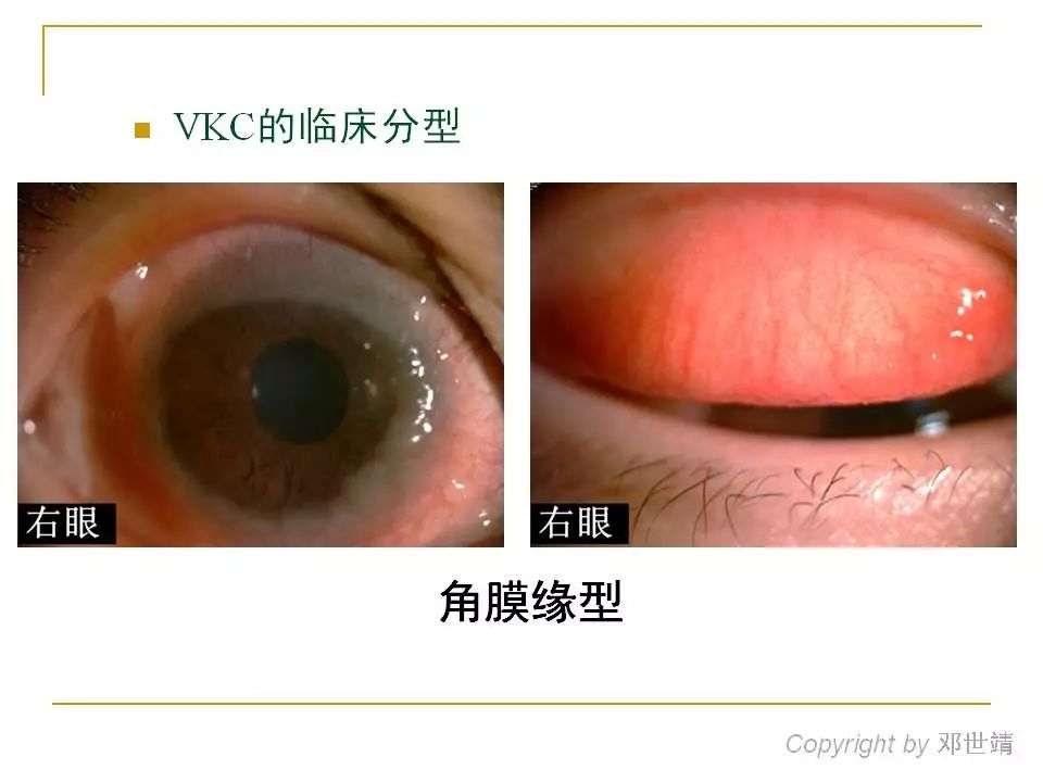 眼睛过敏如何预防,治疗眼周围过敏方法