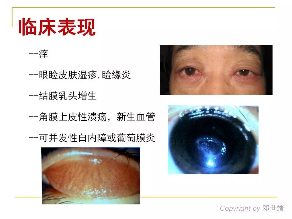 眼睛过敏如何预防,治疗眼周围过敏方法