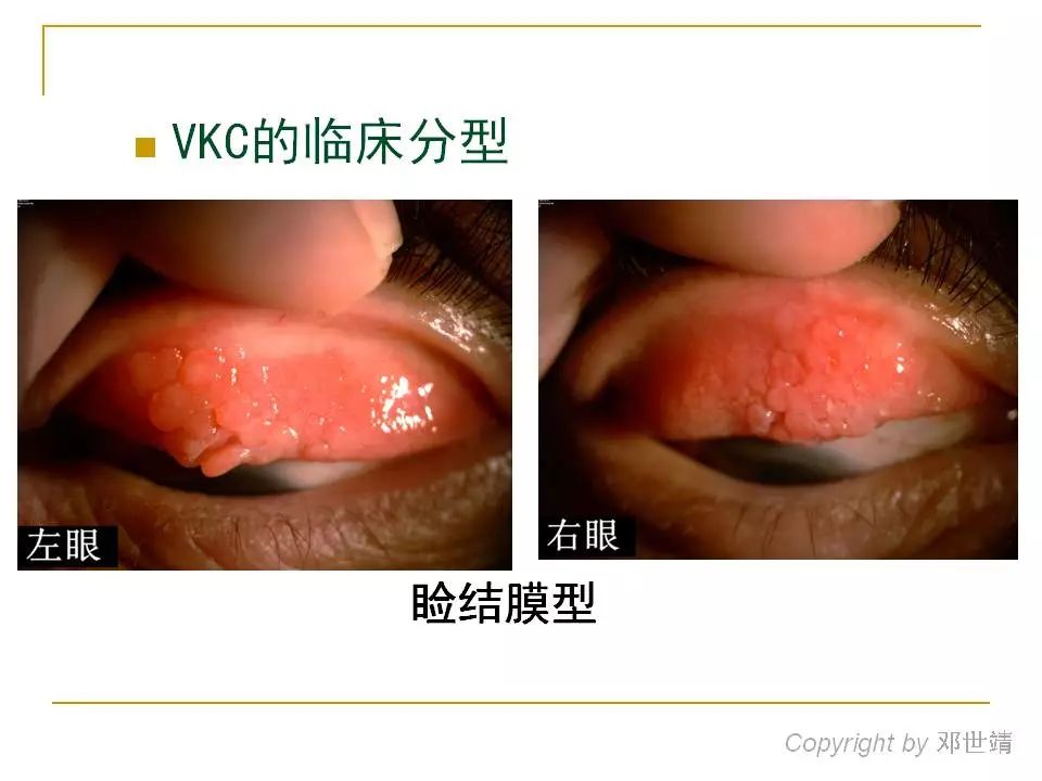 眼睛过敏如何预防,治疗眼周围过敏方法