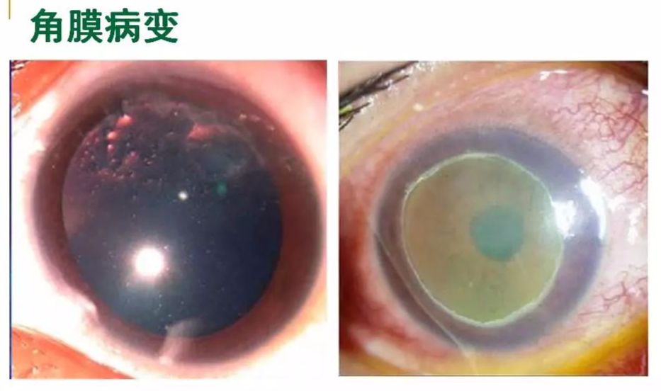 眼睛过敏如何预防,治疗眼周围过敏方法