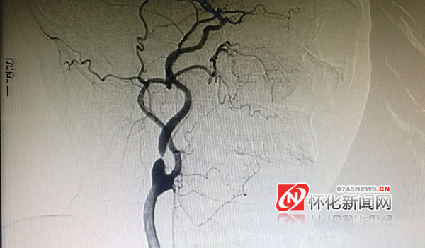 脑袋动脉瘤破裂大面积出血,头痛一下突然很慌担心脑出血