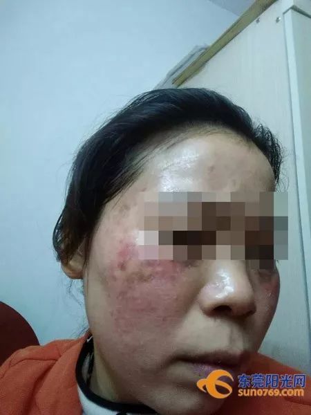 面部祛斑遭毁容,祛斑毁容真实案例