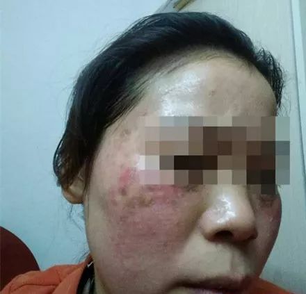 常州这种地方整容不失败才怪!2名女子为变美,一个差点眼瞎一个脸变猪头!