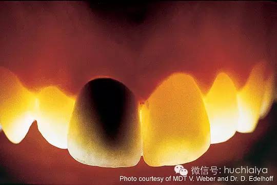 金属烤瓷牙不如全瓷牙好看