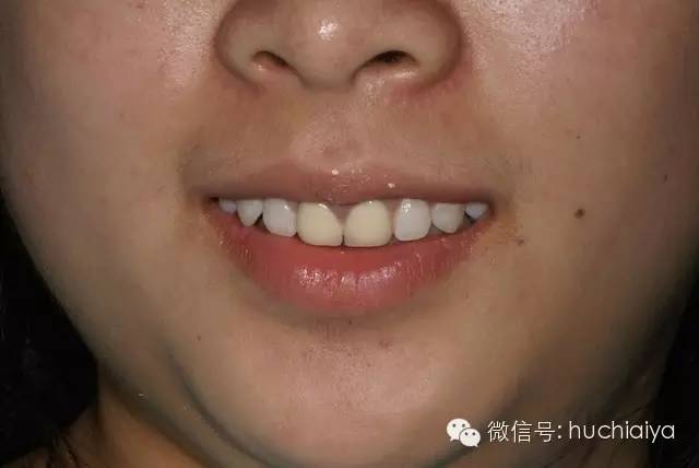 金属烤瓷牙不如全瓷牙好看
