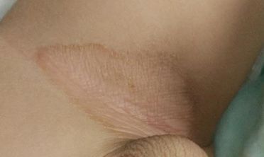 皮疹不吃药能自愈吗,皮疹一天就自愈了