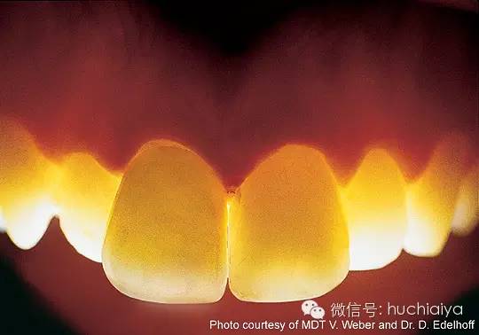 金属烤瓷牙不如全瓷牙好看