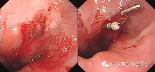 酒后吐血挂什么科,酒后吐血怎么止血