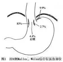 酒后吐血挂什么科,酒后吐血怎么止血