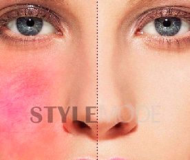 皮肤泛红敏感长痘如何修复,过敏性肌肤怎么治疗最好