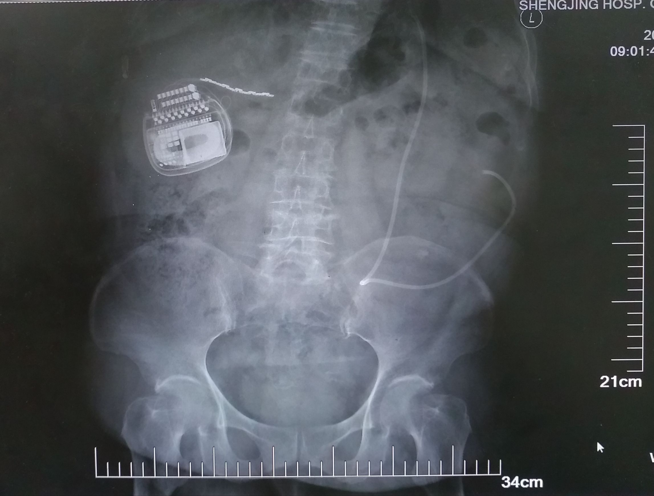 胆囊癌手术后全身疼怎么回事,胆囊癌手术后一直疼正常吗