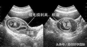 孕5-6周早期少量出血不要紧张,孕6周早期出血