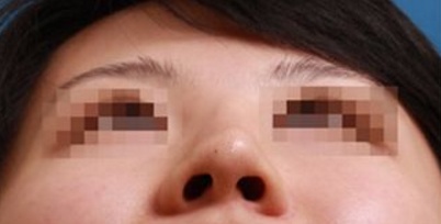 情人节“*力暴**亲热”！做过隆鼻后会被撞歪？