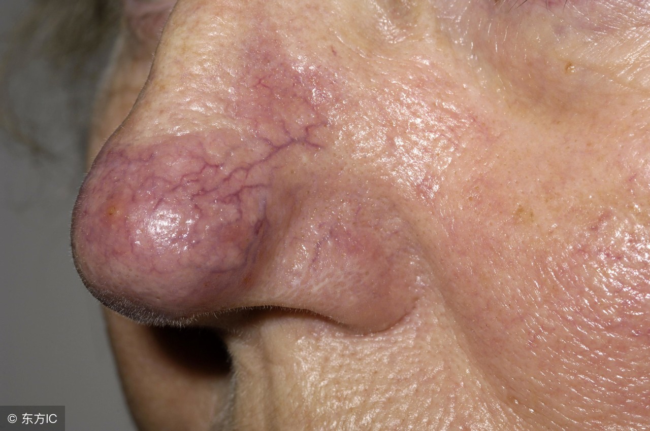 酒糟鼻的症状有哪些,红鼻子酒糟鼻的症状