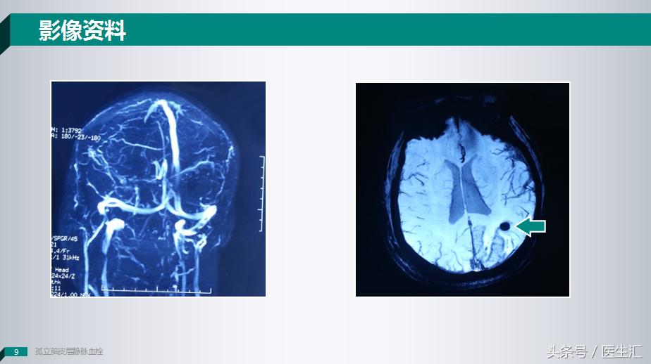 做了好多检查都正常就是发烧,做了好多检查都正常