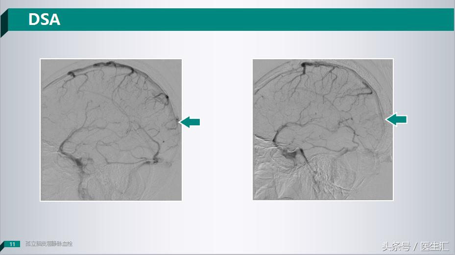 做了好多检查都正常就是发烧,做了好多检查都正常