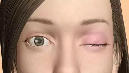 重症肌无力和神经损失哪个严重,重症肌无力晚年