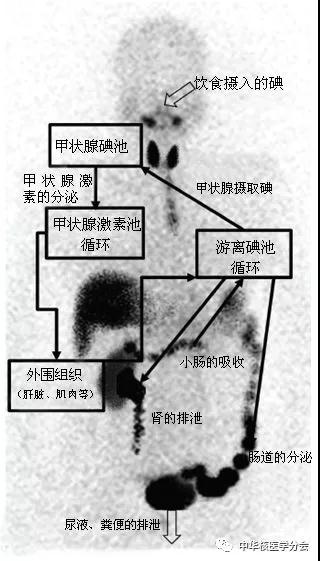 甲状腺癌进行碘治疗后有什么反应,甲状腺癌碘治疗后淋巴还有结节