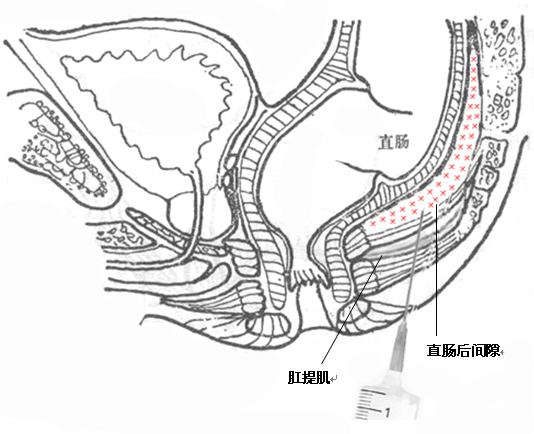 酸可收敛，涩可固脱，注射固脱技术让懂的人明白，医学需要创意