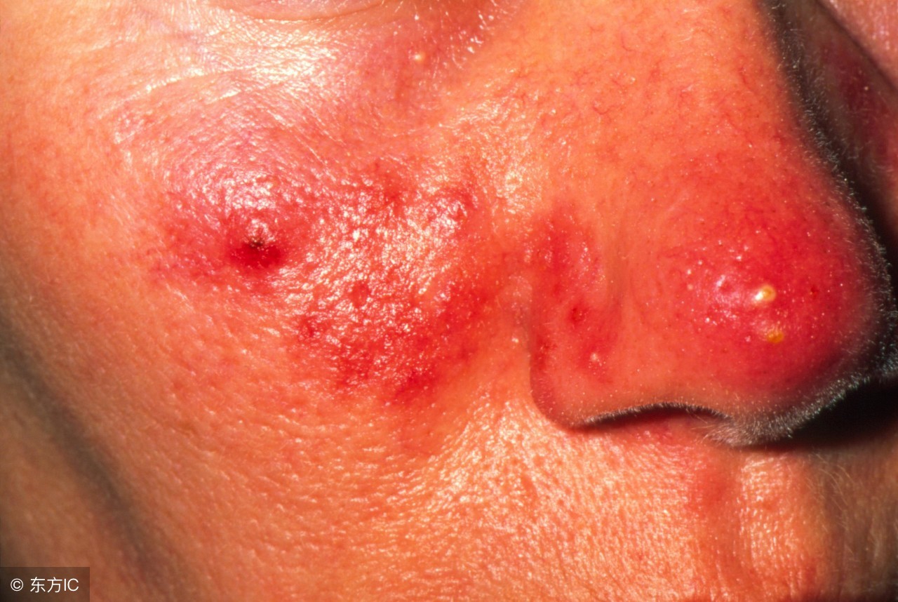 酒糟鼻的症状有哪些,红鼻子酒糟鼻的症状