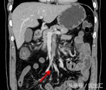 间歇性反酸、腹痛、呕吐咖啡色液体