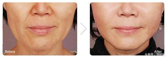 医美助力逆转修复,医美可以抵抗断崖式衰老吗