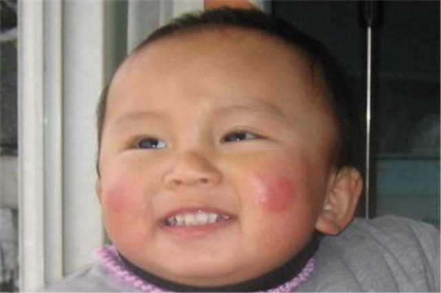 宝宝冬天手长冻疮,宝宝冻疮的原因及治疗方法