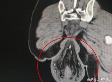 蹲厕所玩手机超过20分钟,男性久蹲厕所玩手机