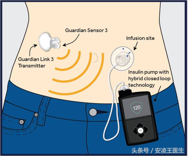 动态血糖曲线分析,血糖数据预测算法
