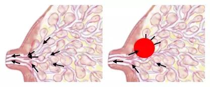 奶结会消失吗,奶结久了会自动消去吗