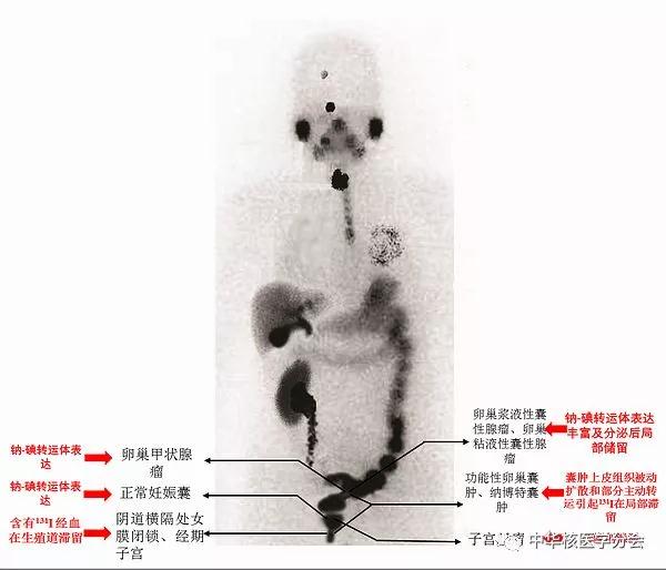 甲状腺癌进行碘治疗后有什么反应,甲状腺癌碘治疗后淋巴还有结节