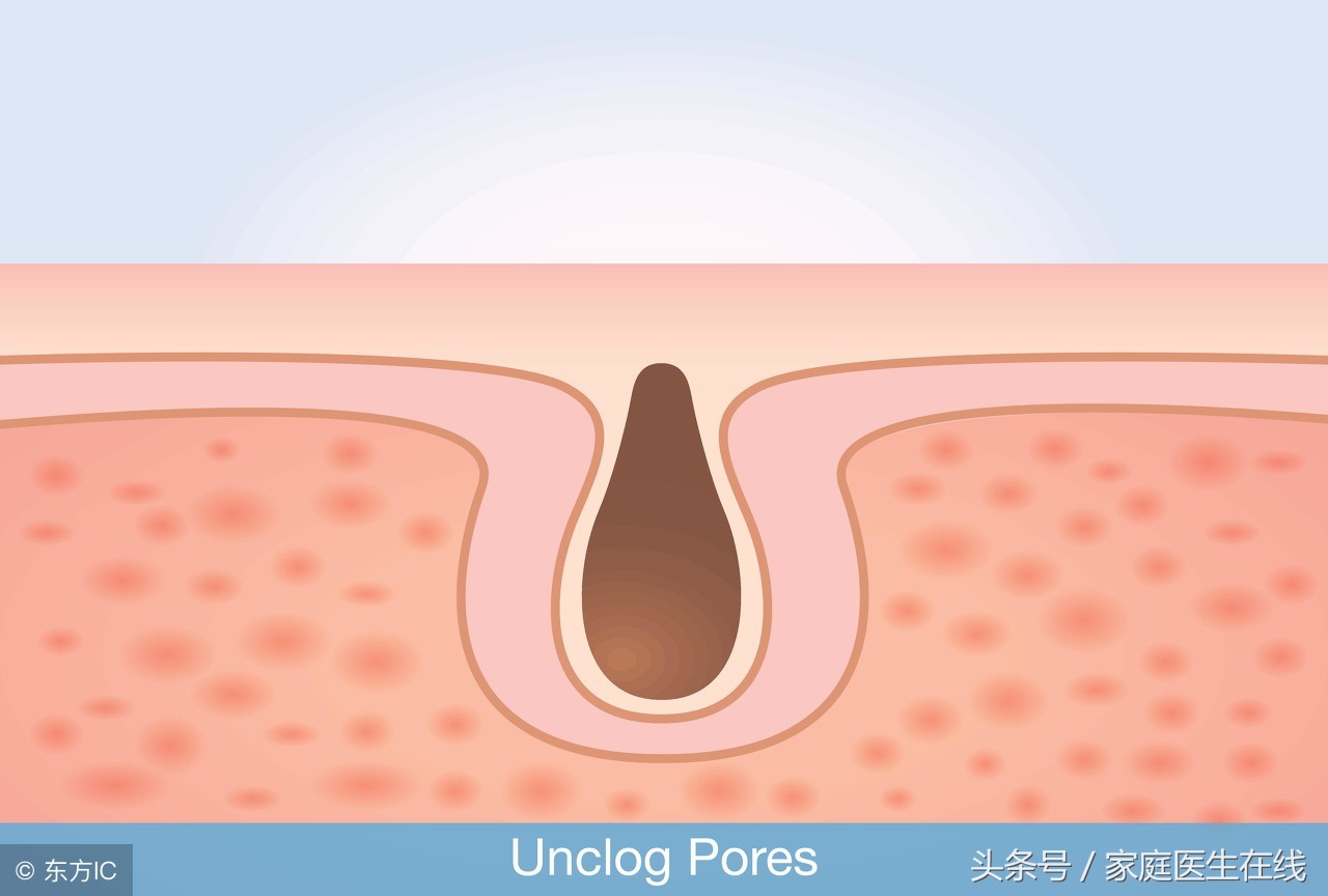 皮肤科医生建议去黑头的最好方法,皮肤科医生教你如何去黑头