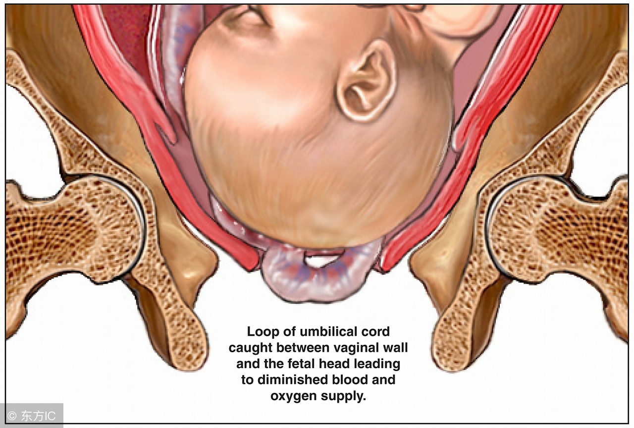 无麻药忍痛剖腹生子,无麻剖腹