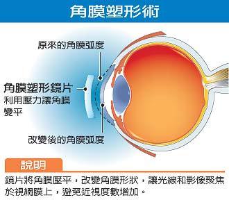 近视角膜塑形镜的利与弊,近视矫正角膜塑形镜价格