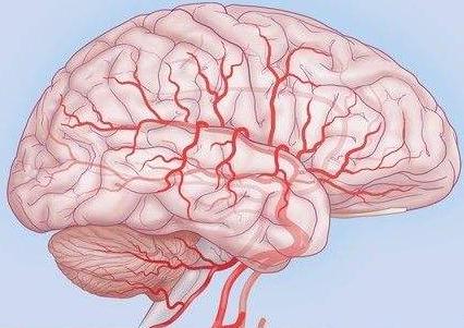 动脉瘤破裂大面积脑梗死后遗症,破裂的脑动脉瘤治愈几率