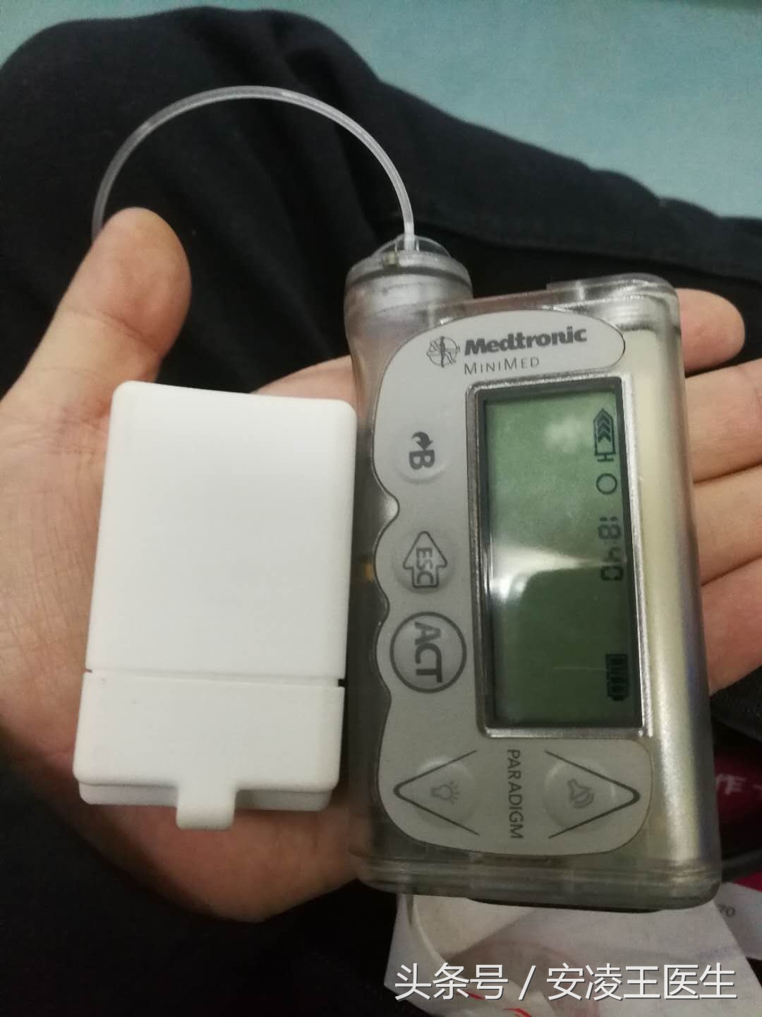 动态血糖曲线分析,血糖数据预测算法