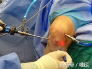 半月板损伤科普,膝盖半月板撕裂软骨脱落