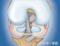 半月板损伤科普,膝盖半月板撕裂软骨脱落