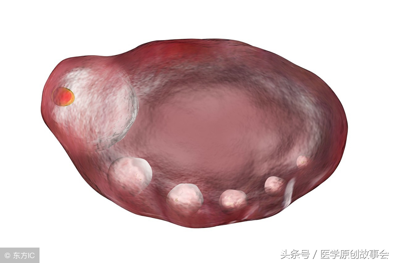25岁白领卵巢黄体破裂，急诊抢救三小时，医生说都是丈夫害的！