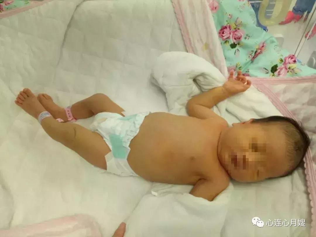 黄疸最怕的克星是什么,急性黄疸最怕什么