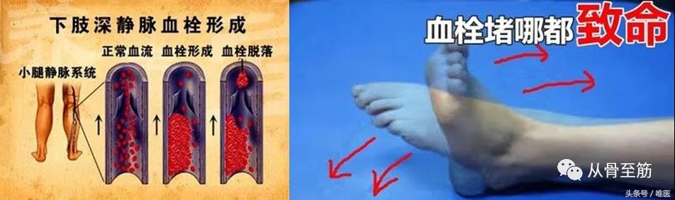 小血栓如何治疗,提前发现血栓小妙招